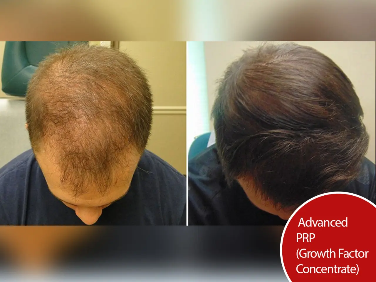 PRP-Treatment.jpeg (1)