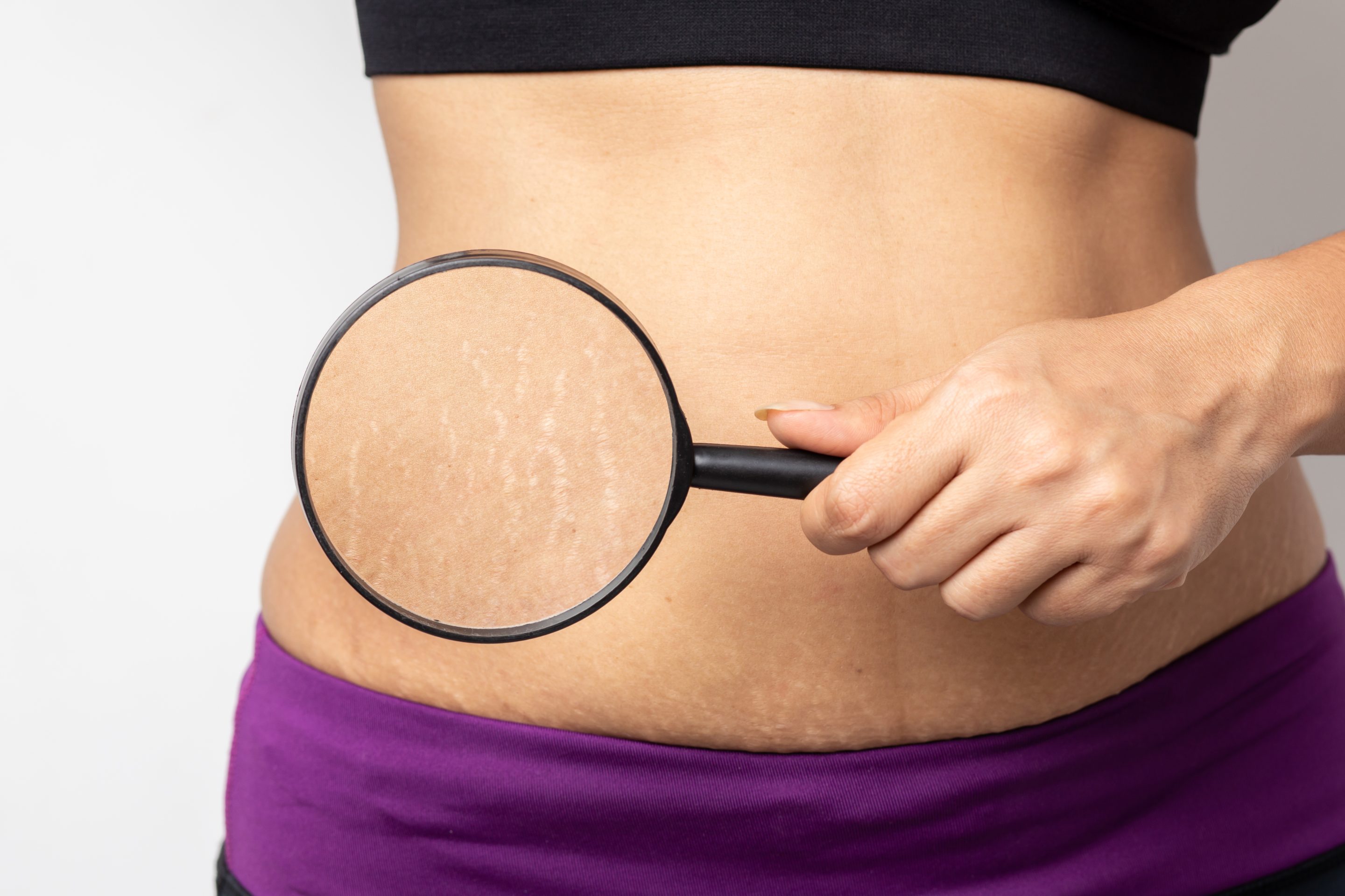 Stretch Mark Removal Treatment