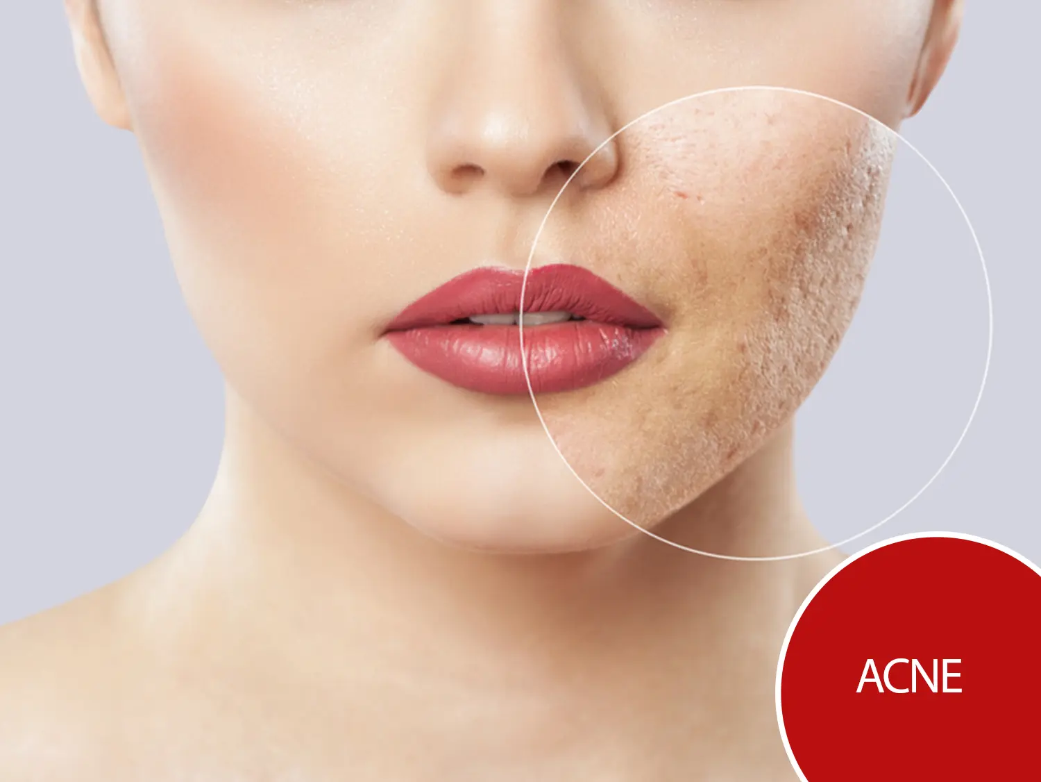 Acne Treatment