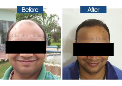 Chandra Clinic Hair transplant Before after male