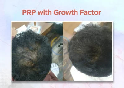 Chandra Clinic PRP with growth factor