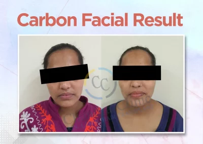 Chandra Clinic carbon facelift