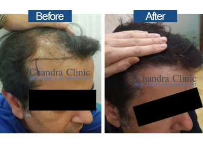 Chandra Clinic hair treatment before after