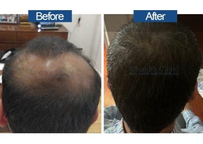 Chandra Hair transplant before after