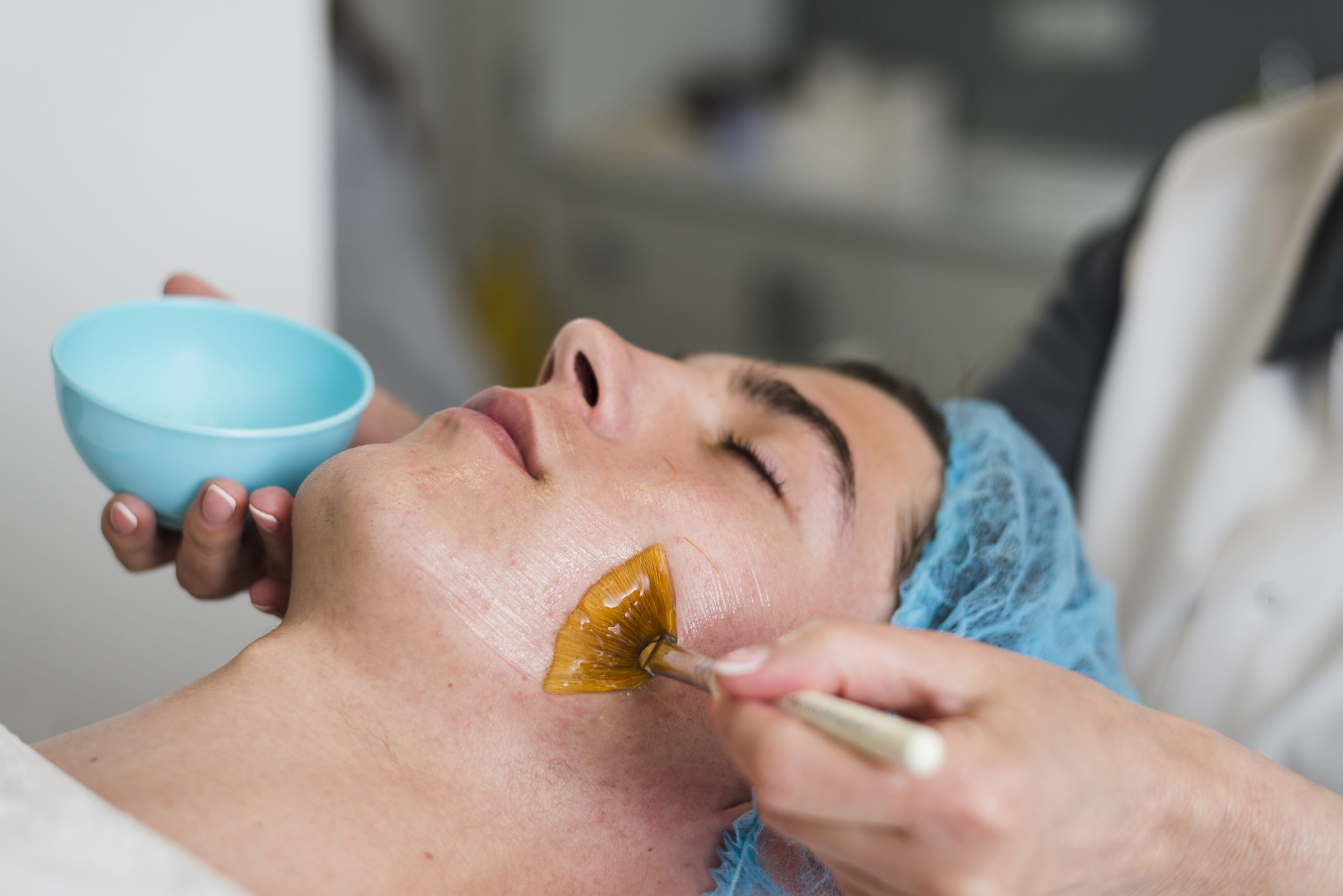 Benefits of Chemical Peels Treatment