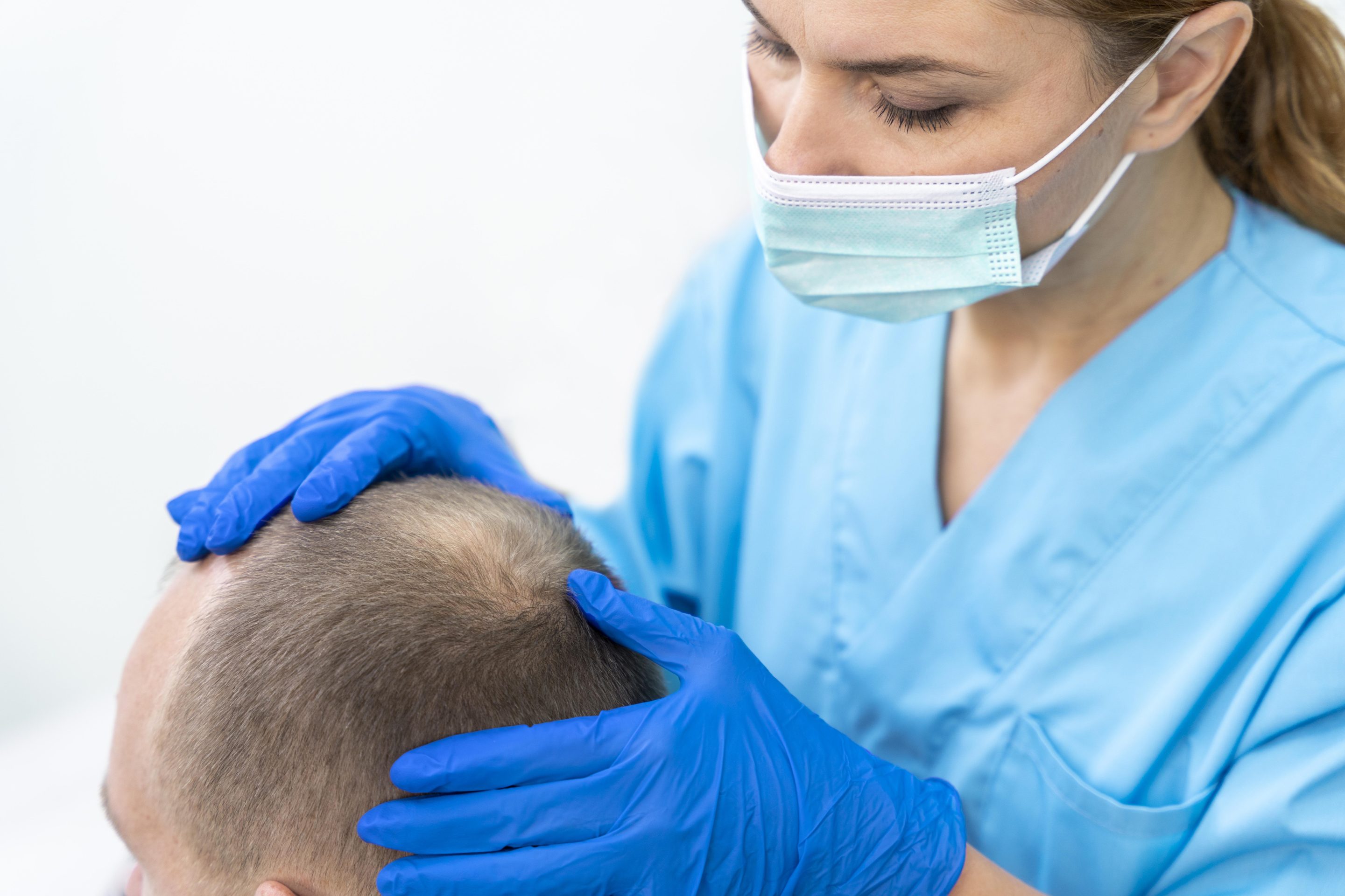 Unshaven Follicular Unit Extraction (FUE) Hair Transplant