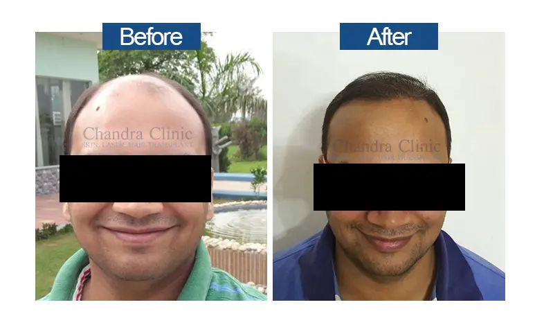 Hair transplant Surgery Before and after in Delhi
