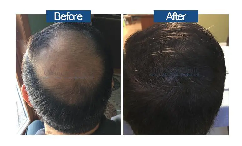 Hair transplant Surgeon in Delhi