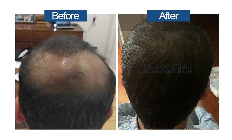 Hair transplant in Delhi