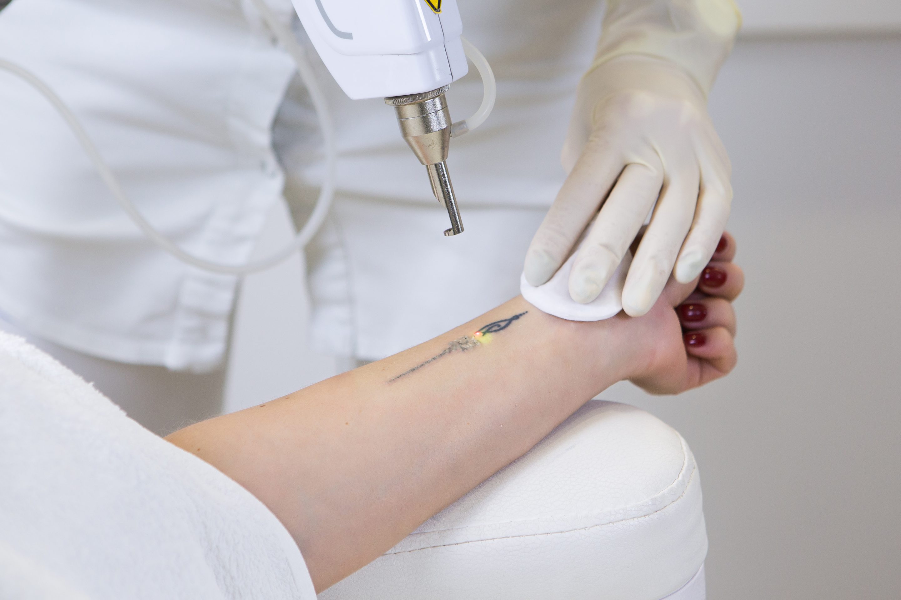 Laser Treatment For Tattoo Removal