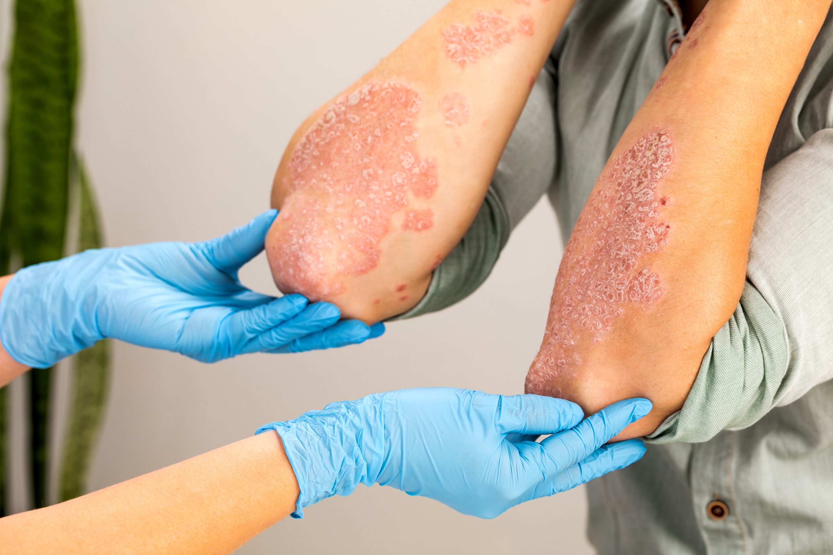 Benefits of Psoriasis Treatment:<br />
