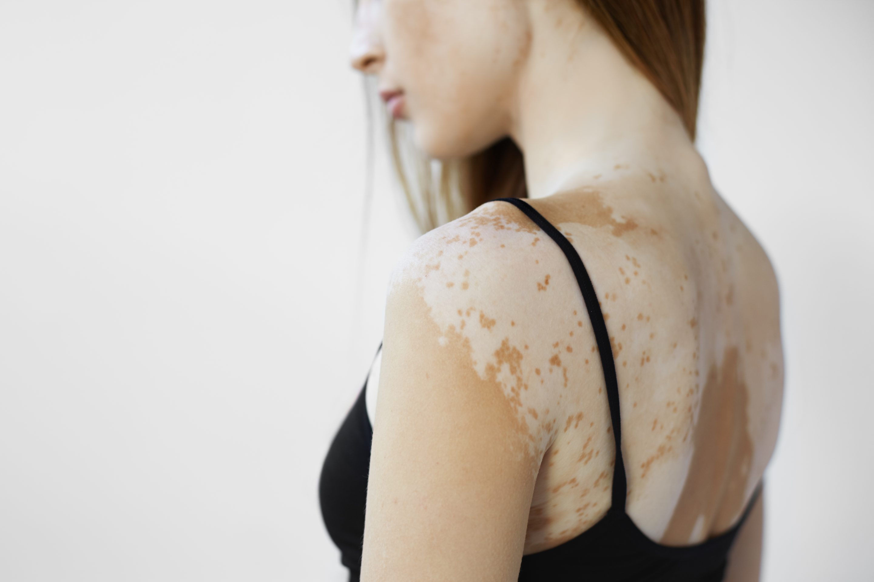 How to Prepare for the Vitiligo Treatment?
