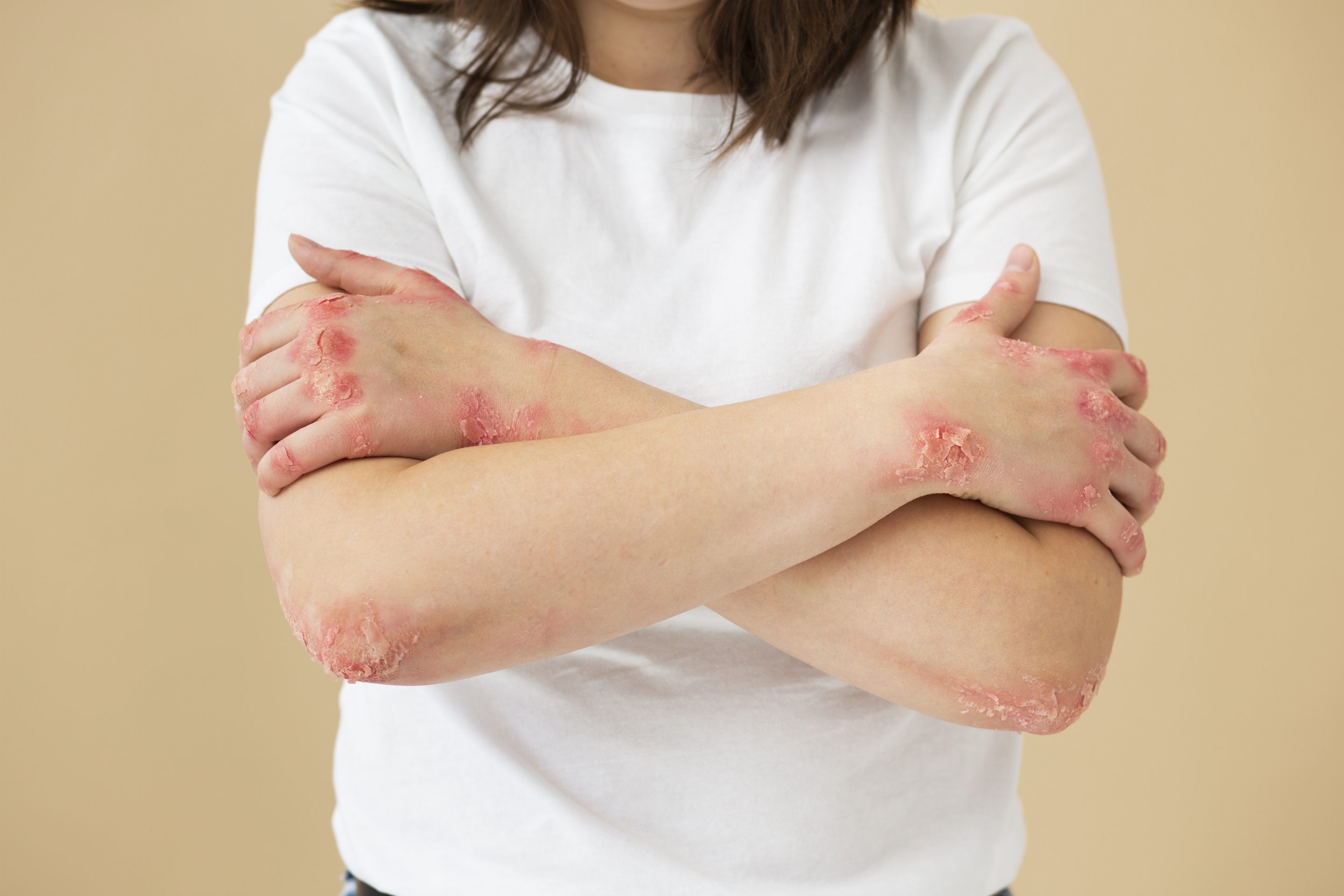 tinea Treatment 