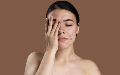 Different techniques for Acne Scar reduction