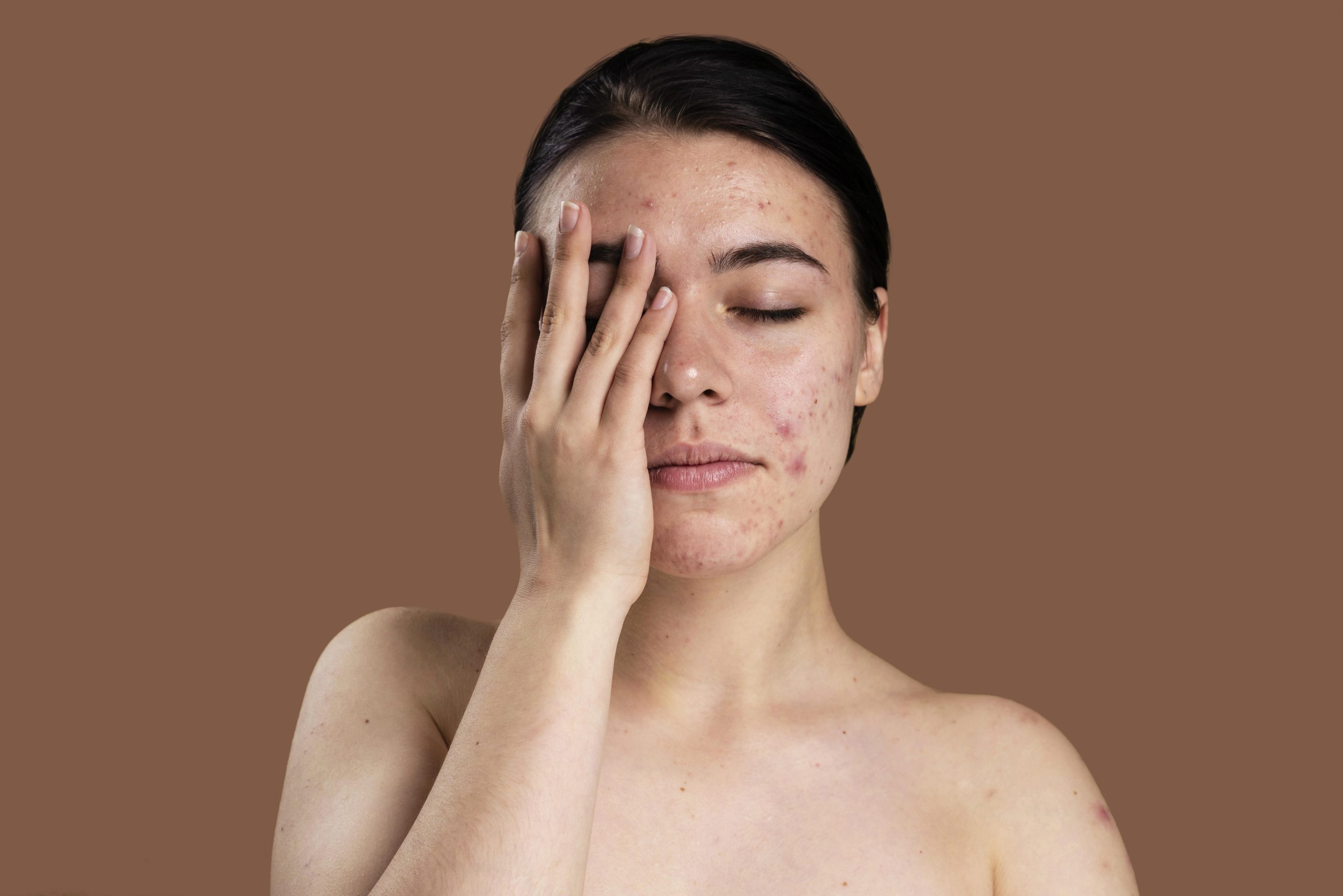 Recovery of acne