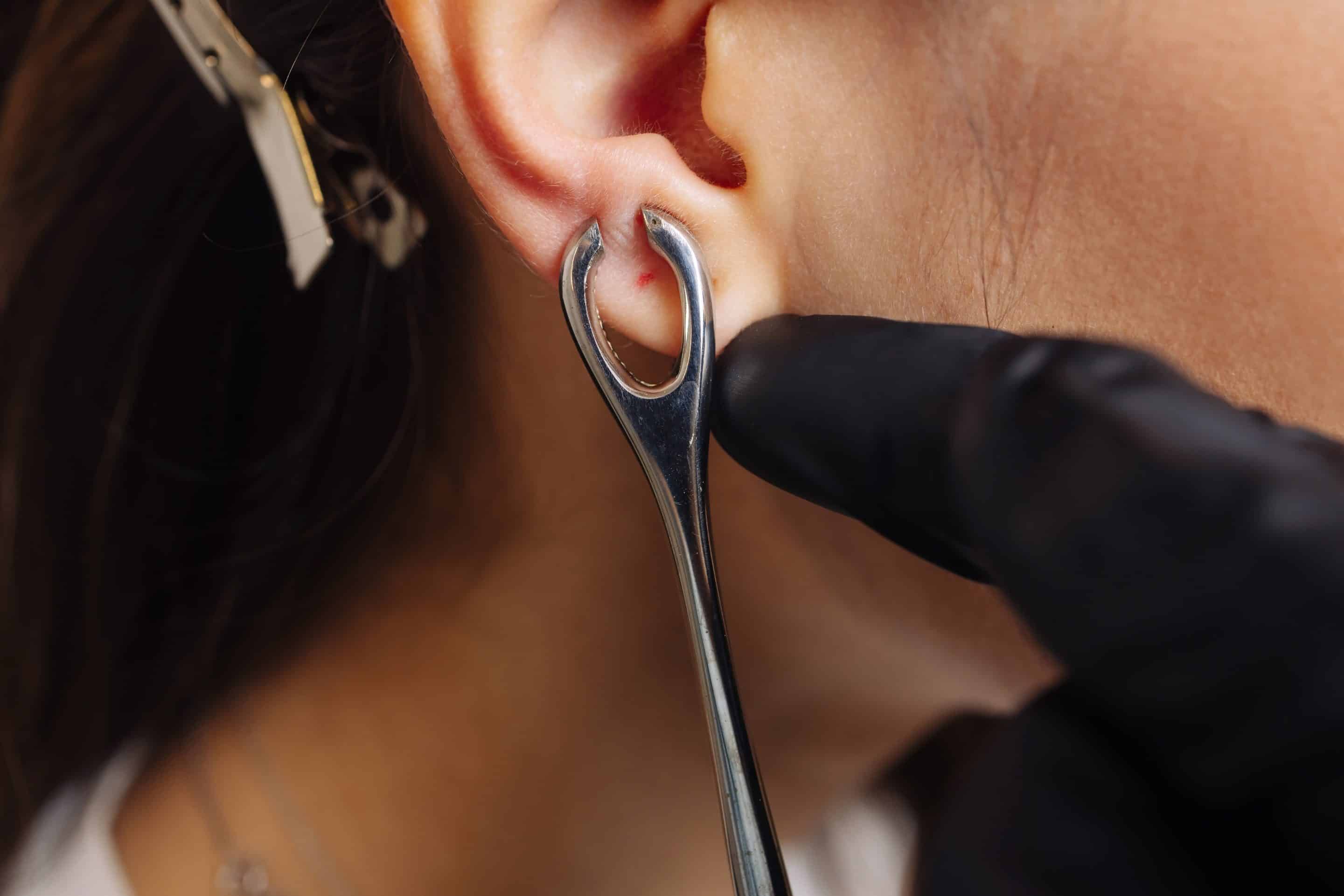 earlobe repair surgery Process