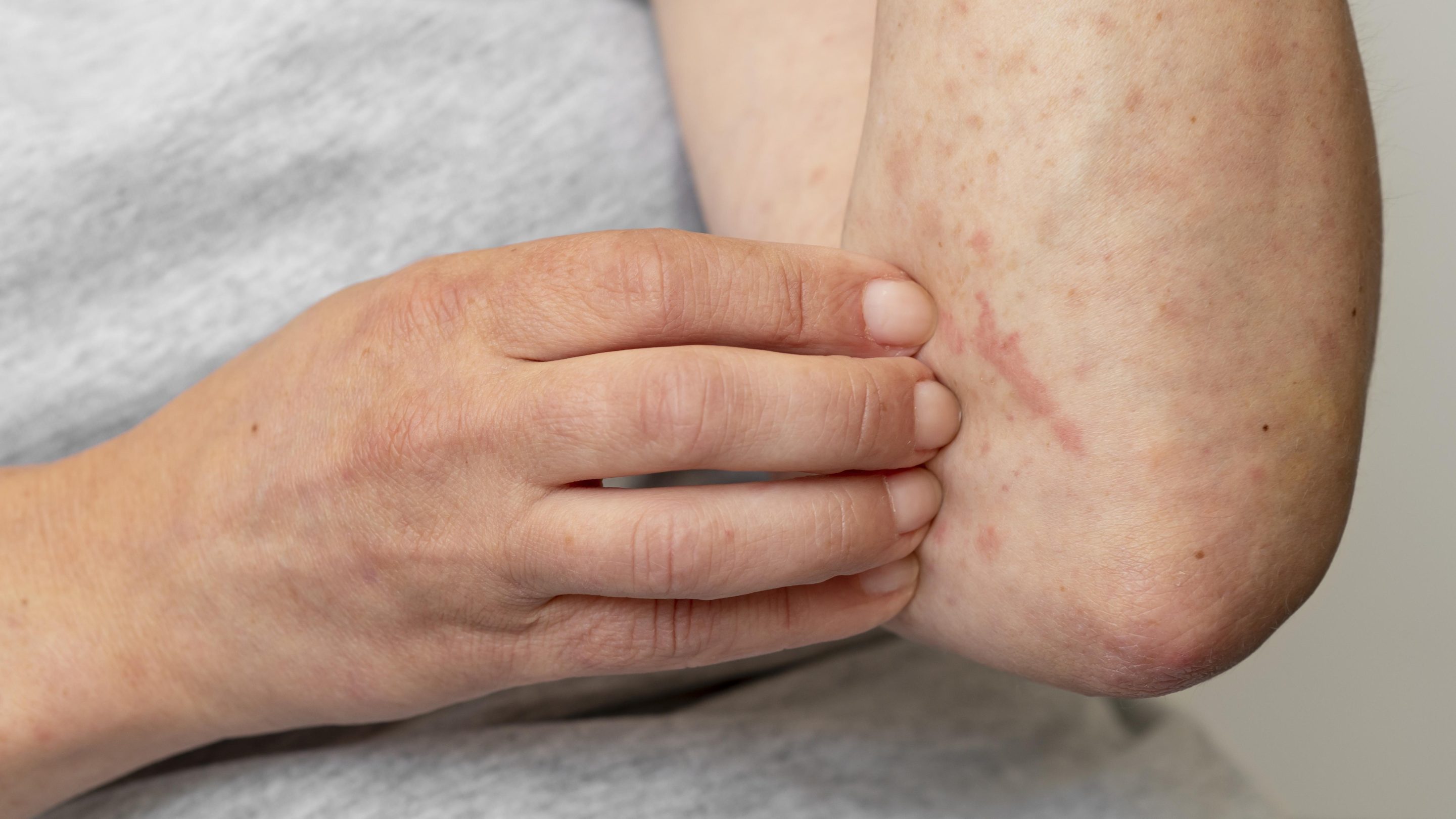 How to Prepare for the Psoriasis Treatment