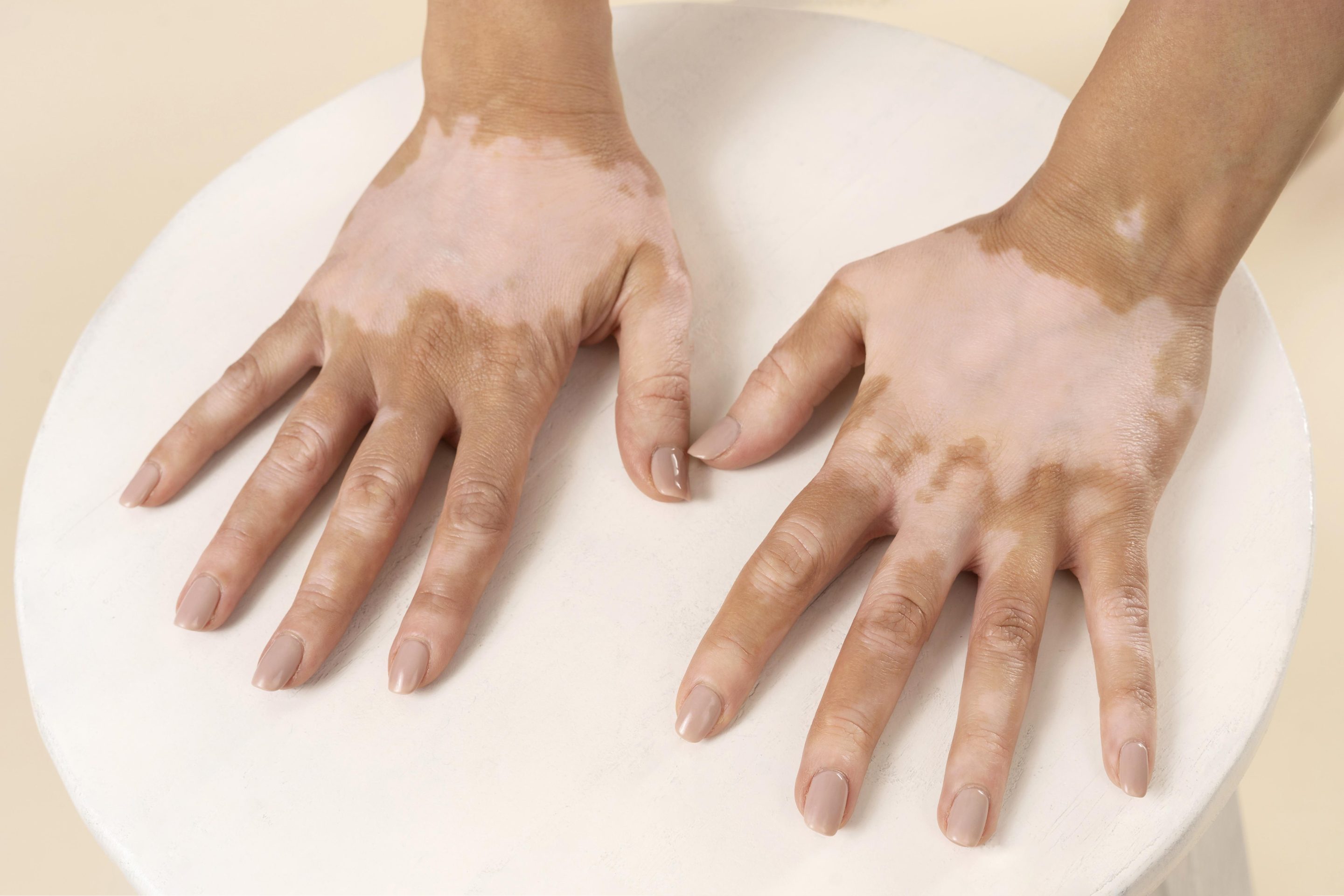 vitiligo Treatment in Delhi