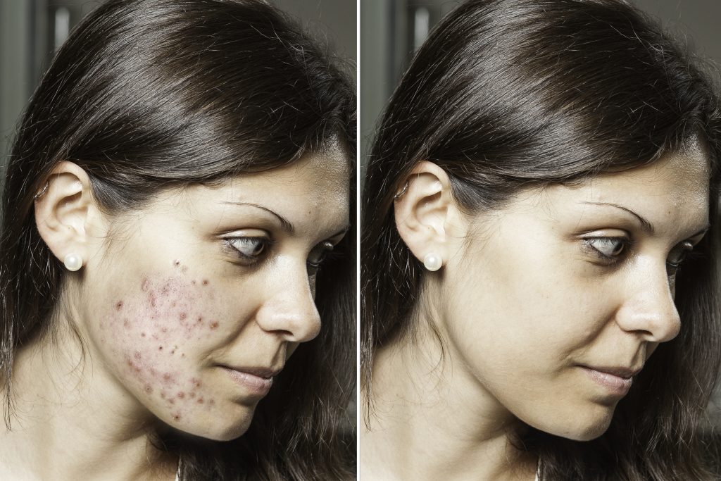 Acne Scar Surgery